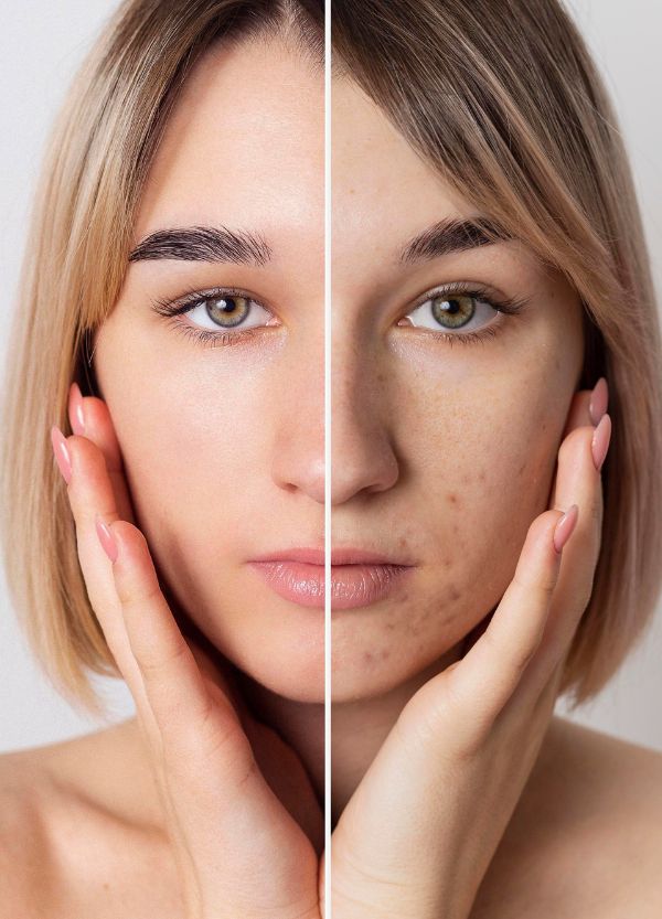 Sun damage skin
