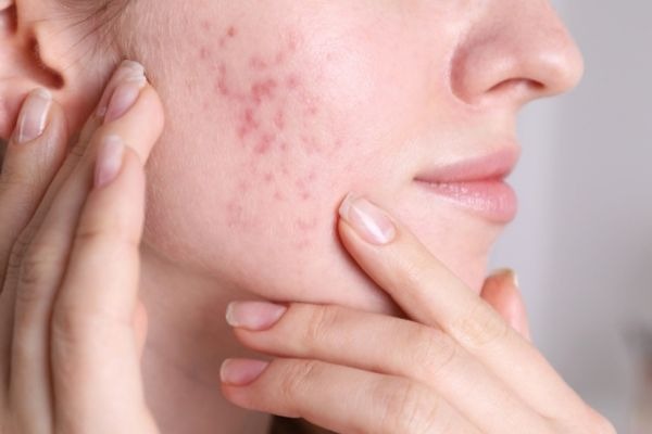 Acne Scar